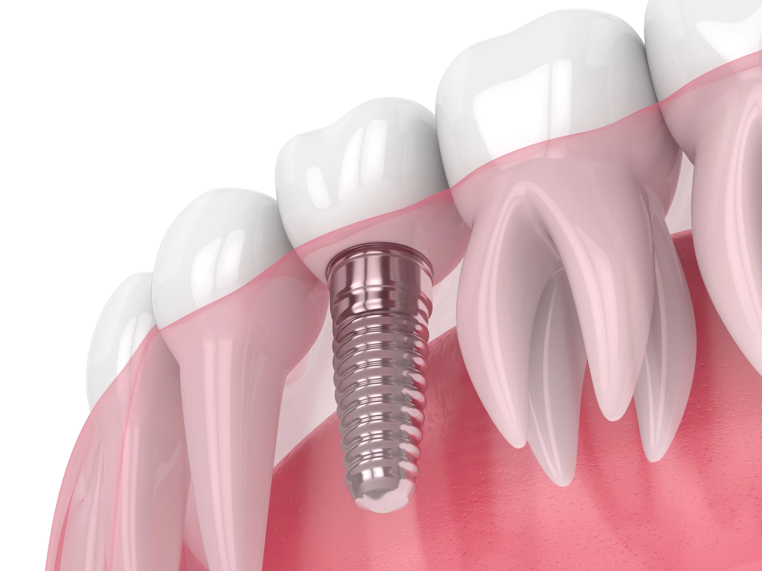 Dental-Implants