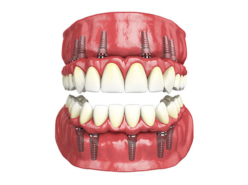 Hybridge Full Mouth Restoration