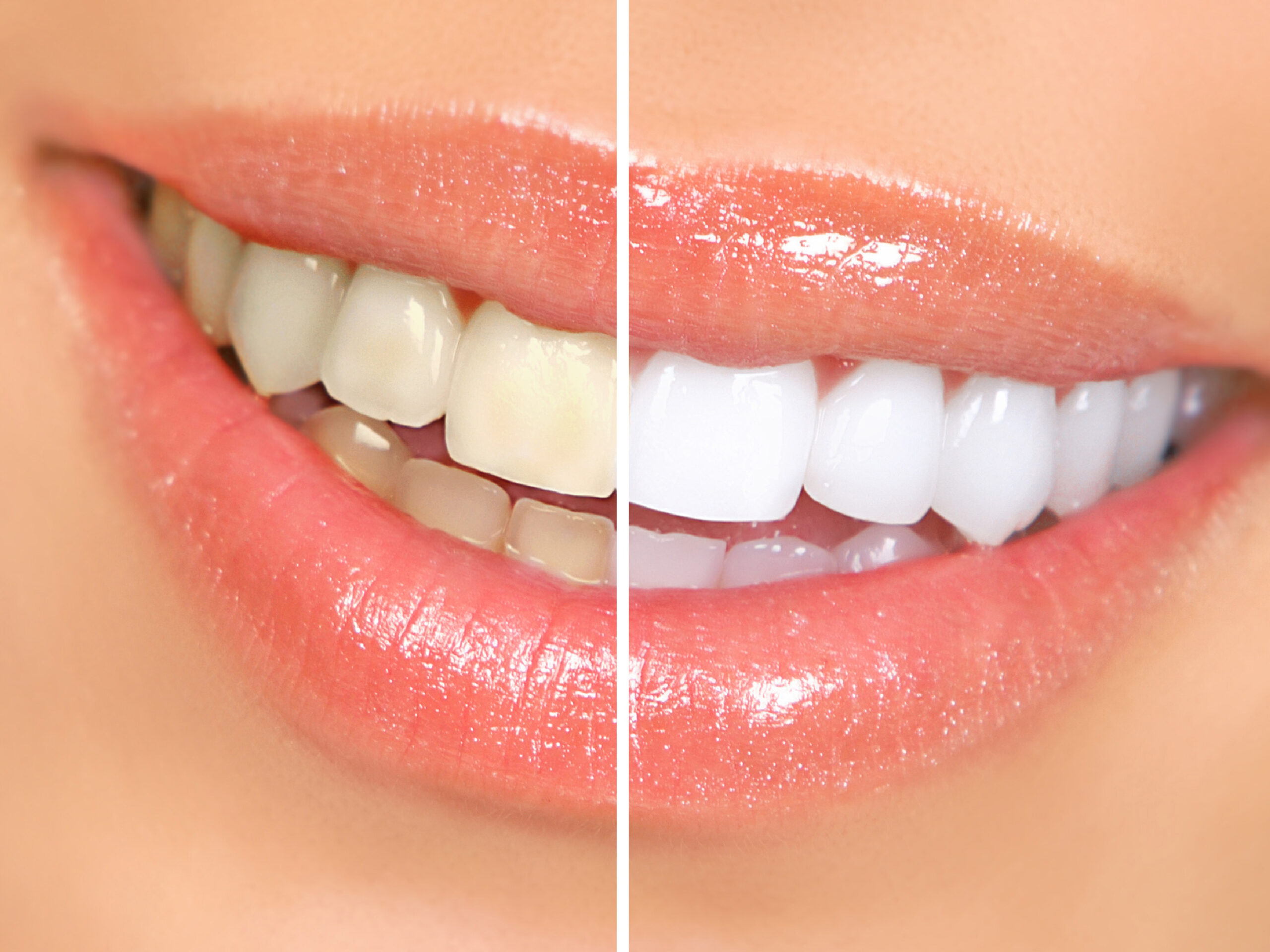 Teeth Whitening-08